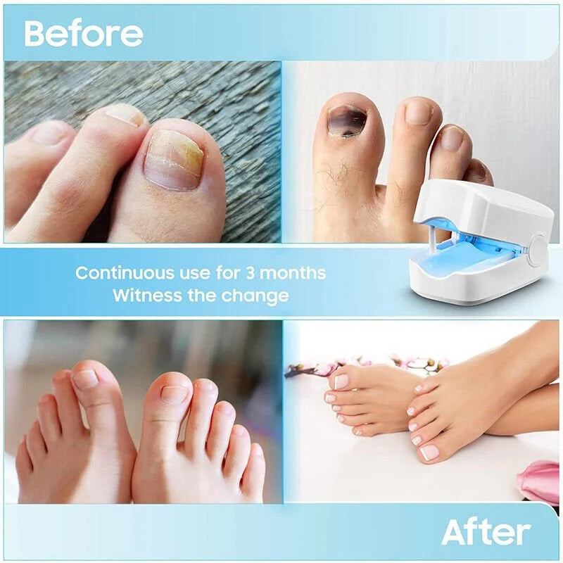 LED Laser Device for Nail Fungus Treatment